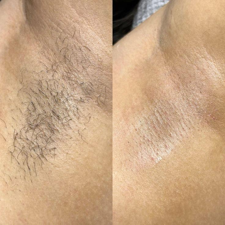 Mersin Lazer Epilasyon, Mersin Lazer Epilasyon Fiyatları, Lazer Epilasyon Mersin, Mersin Lazer Epilasyon Yapan Yerler, Mersin Lazer Epilasyoncu, Mersin Lazer Epilasyon Fiyatı